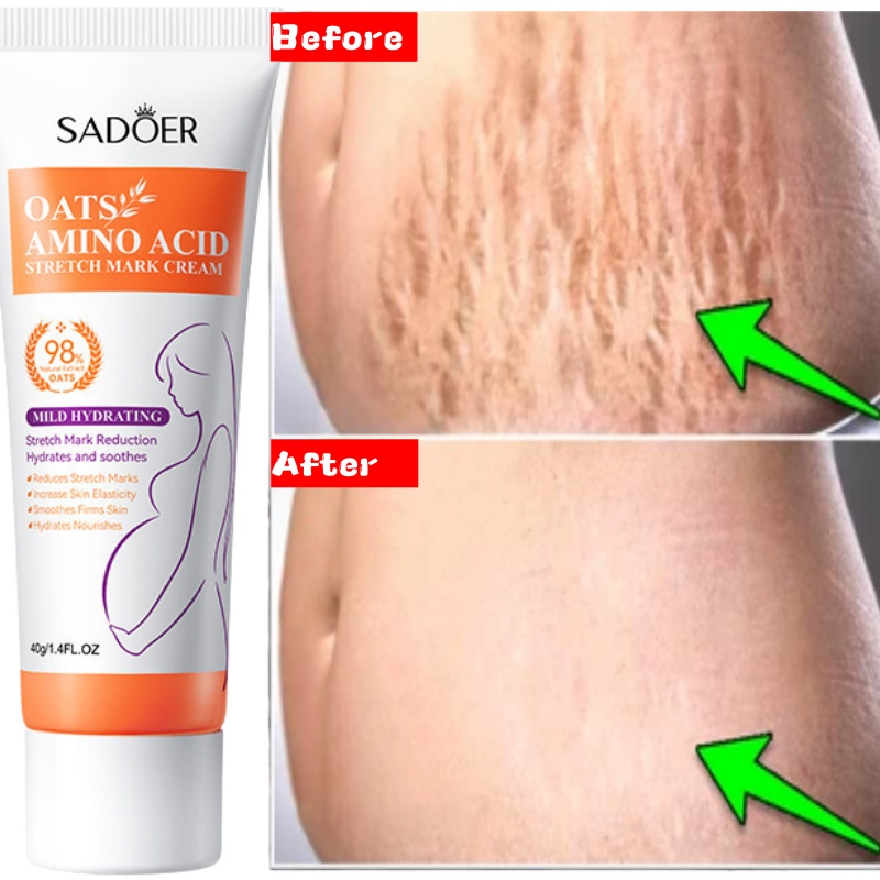 Stretch Marks Permanent Remova - đánh giá và giá Skincare Oat