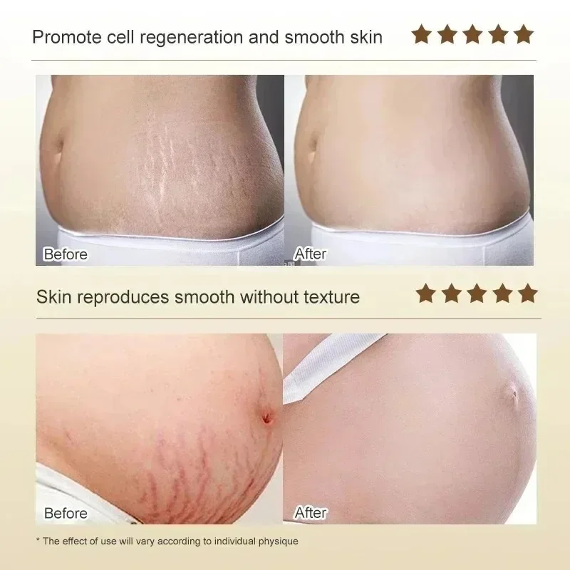 Stretch Marks Permanent Remova - đánh giá và giá Skincare Oat