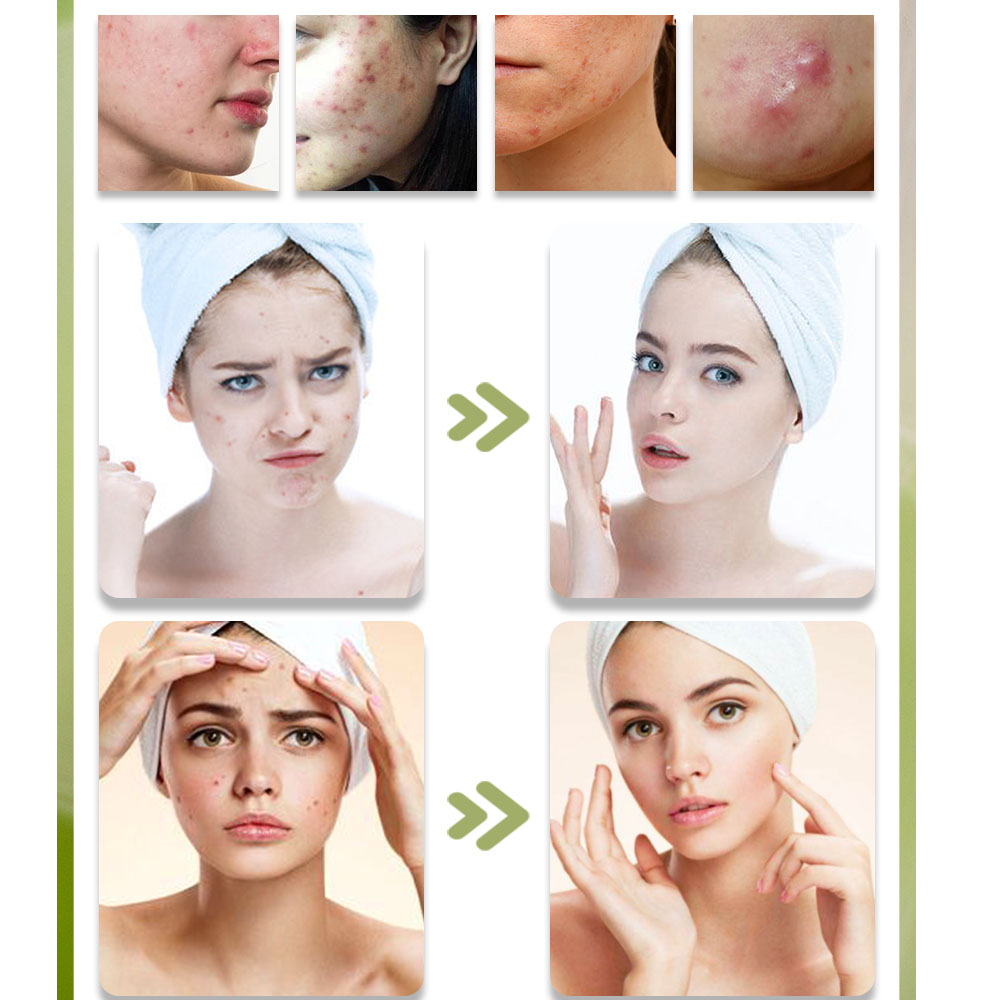 KStims Trị Mụn Tự Nhiên Chống  - đánh giá và giá Tea Tree Spot Treatment